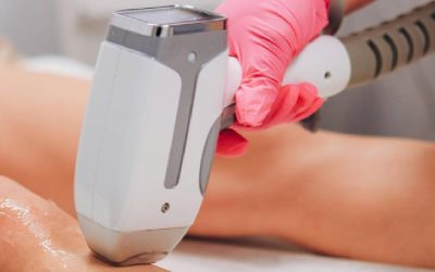 Épilation laser : déroulement et avantages de cet intervention