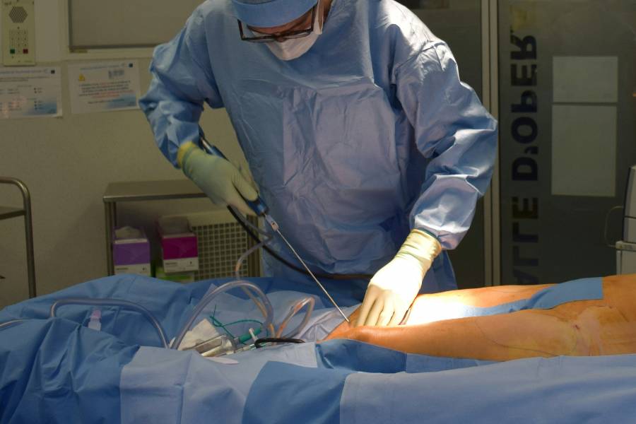 Liposuccion : comment éliminer les graisses tenaces et sculpter sa silhouette efficacement